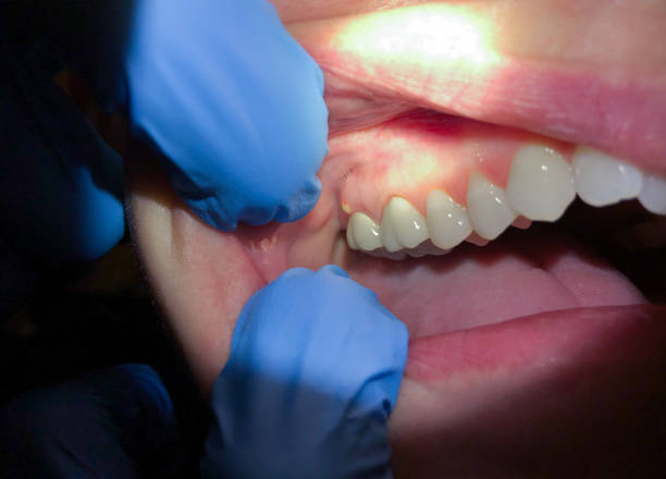 Best Emergency Dentist for Knocked-Out Tooth in Atkins, VA