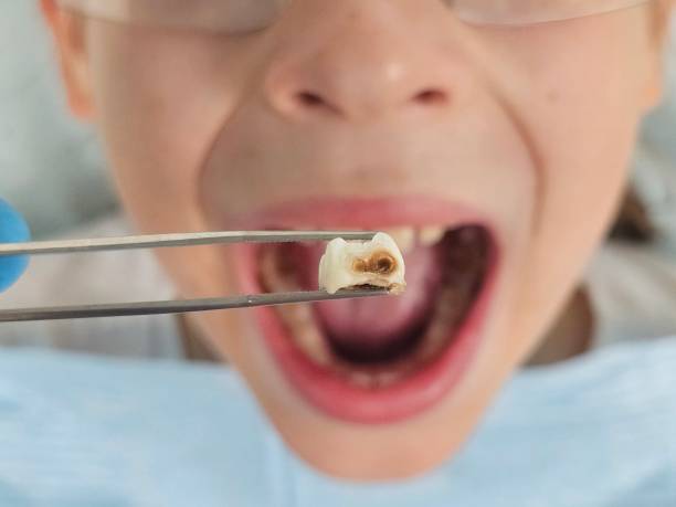 Best Broken or Cracked Tooth Emergency Dentist in Atkins, VA